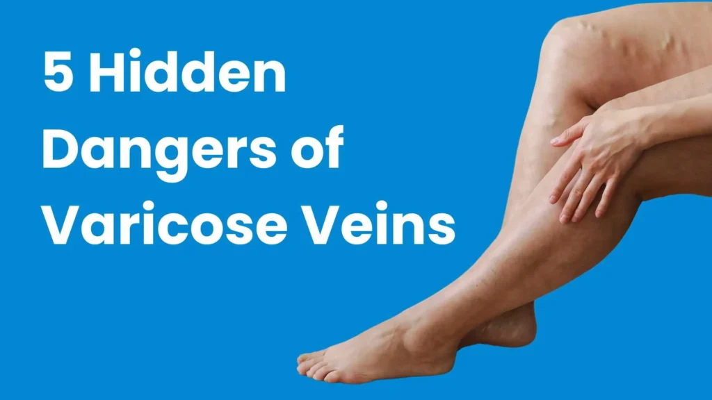 Hidden dangers of varicose veins