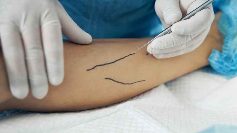 3 Reasons Why Now Is The Best Time For Vein Treatments