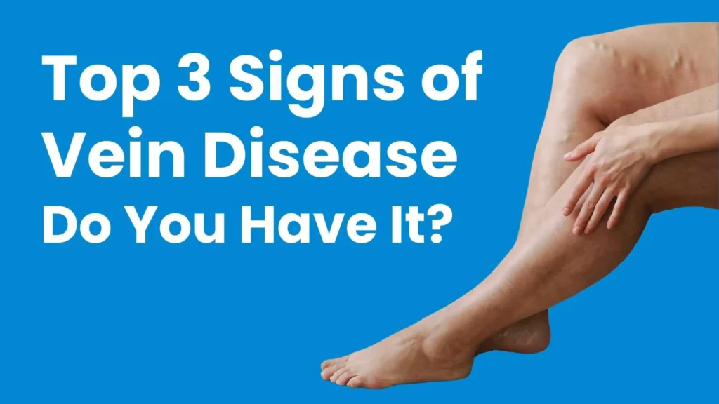 3 signs of varicose veins