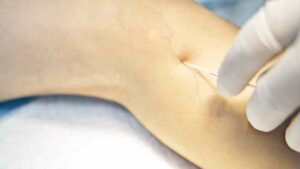 Una propuesta modesta: relojes de pie y tratamientos para las venas