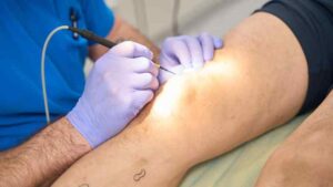 Pregúntele al Dr. Rosen, especialista en venas de Northbrook: Tratamiento con láser