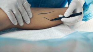 Cuidado de venas Rosen: tratamientos cálidos y reconfortantes, no fríos y punzantes