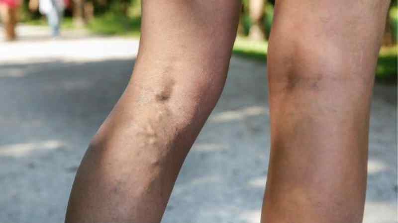 Can Spider Veins Be Removed Comfortably and Effectively?