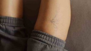 Elige tu AdVEINture: Tratamientos para varices y arañas vasculares