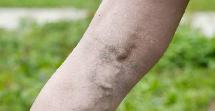 common-causes-of-spider-veins