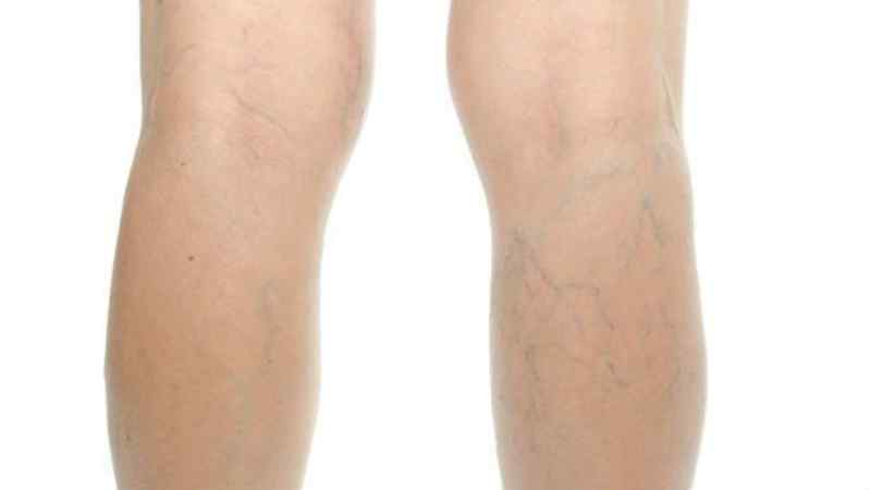 Common Causes of Superficial Venous Insufficiency