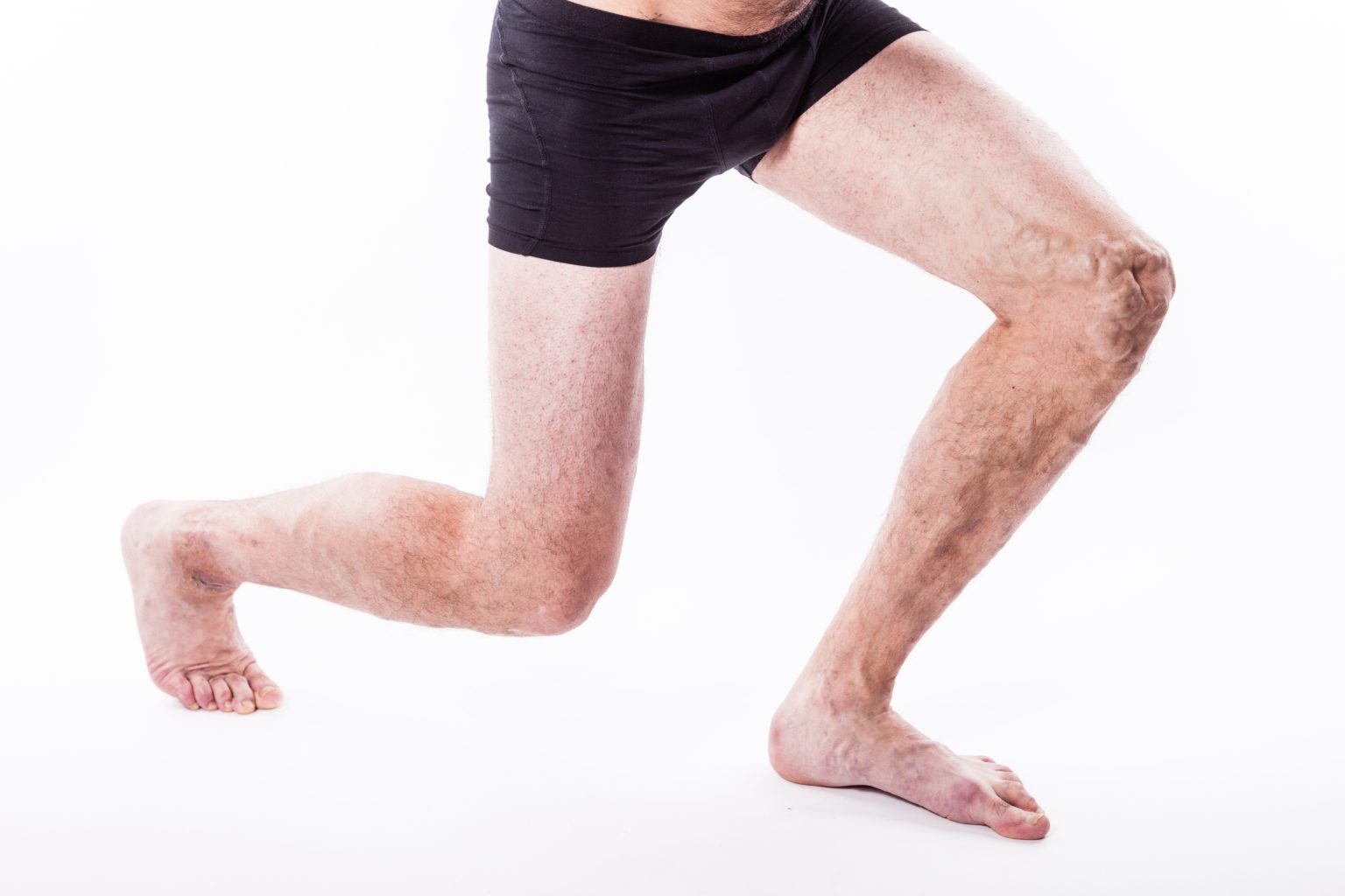Forget the Tie, Get Dad Compression Stockings! Vein Disease in Men