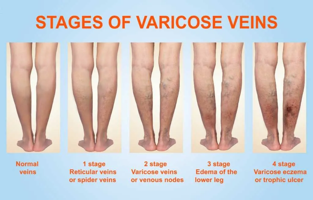 Stages of varicose veins
