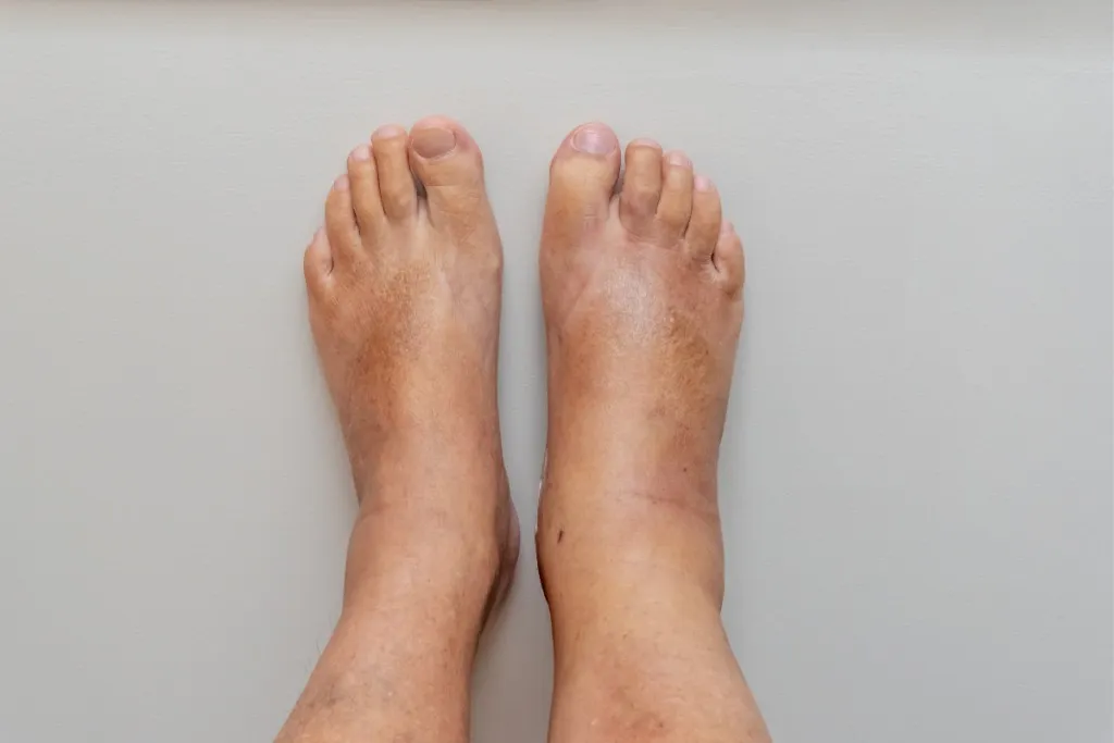 Swollen ankles