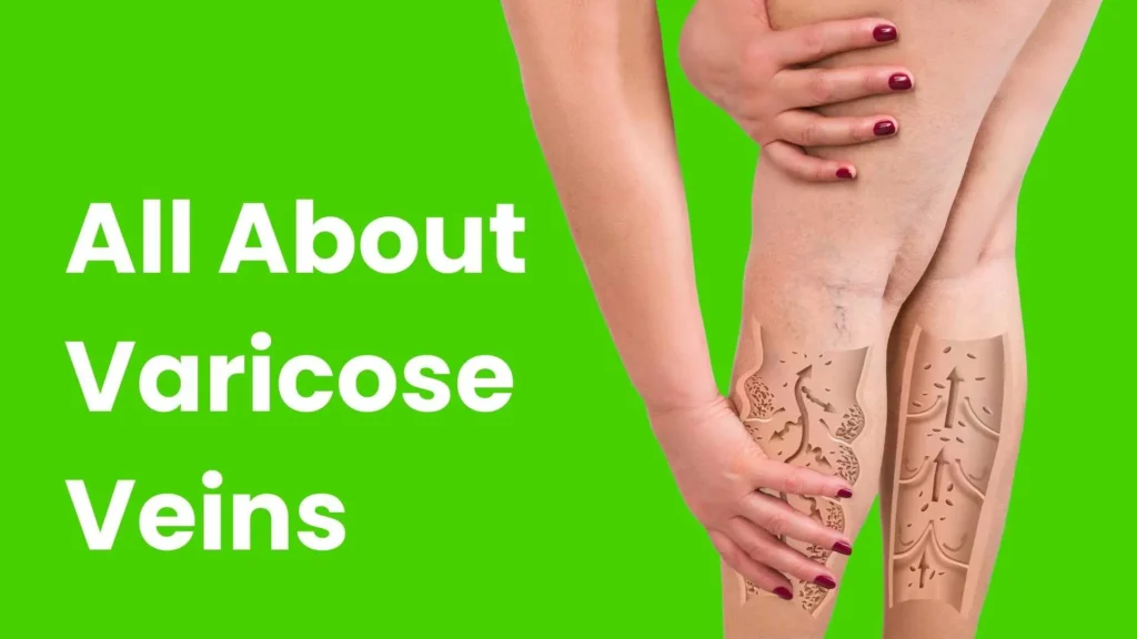 All about varicose veins