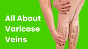 All about varicose veins