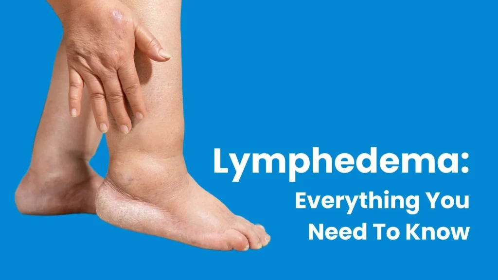 Lymphedema: Everything You Need To Know
