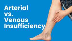 Arterial vs Veneous Insufficiency