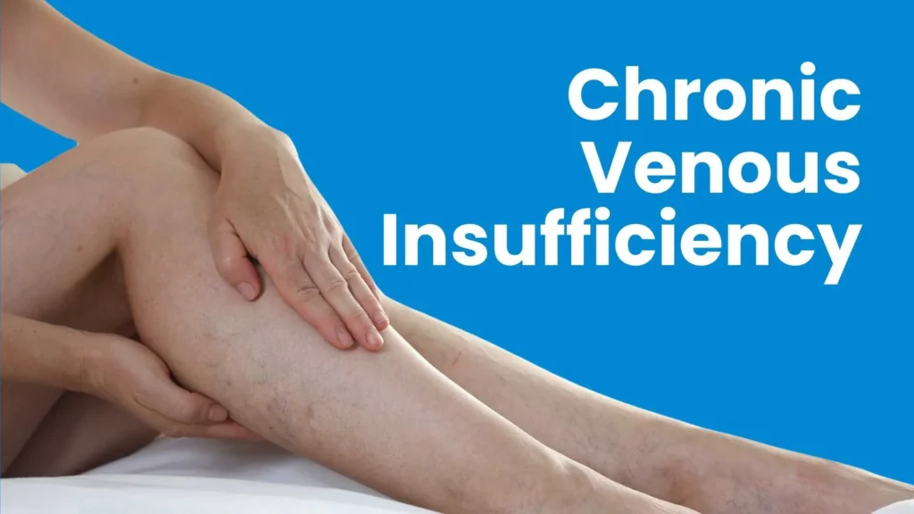 Chronic Venous insufficiency