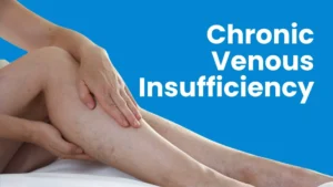 Chronic Venous insufficiency