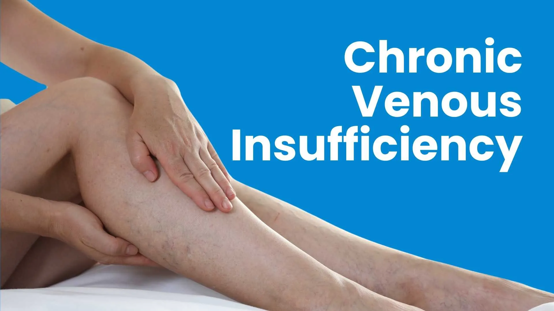 Chronic Venous insufficiency