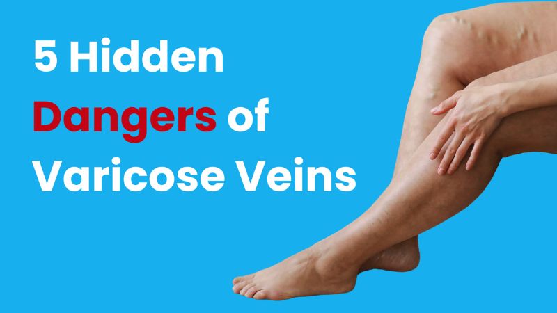 5 hidden dangers of varicose veins