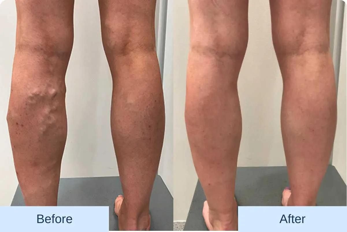 Before vs After treatment image of venous condition.