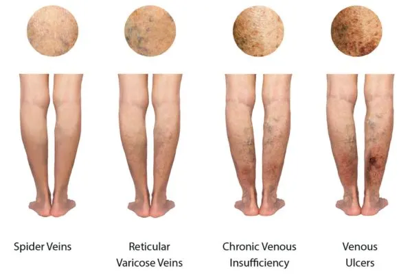 Illustration of reticular veins and chronic venous insufficiency.
