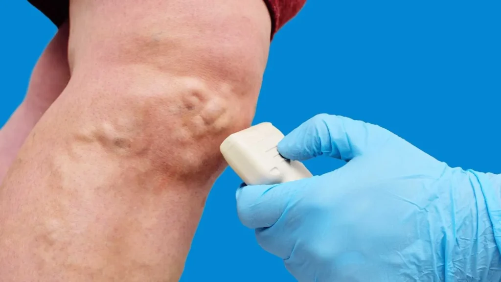 Spider veins