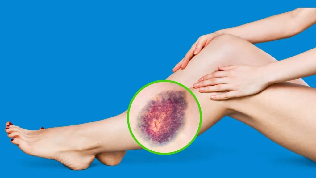 Vein Care