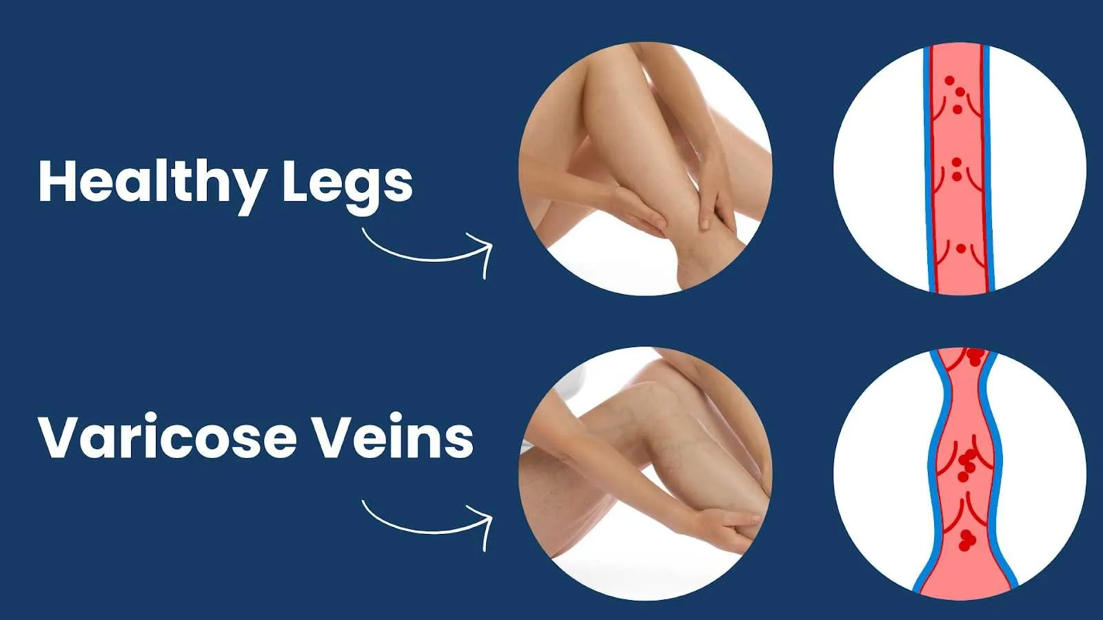 Healthy vs varicose legs