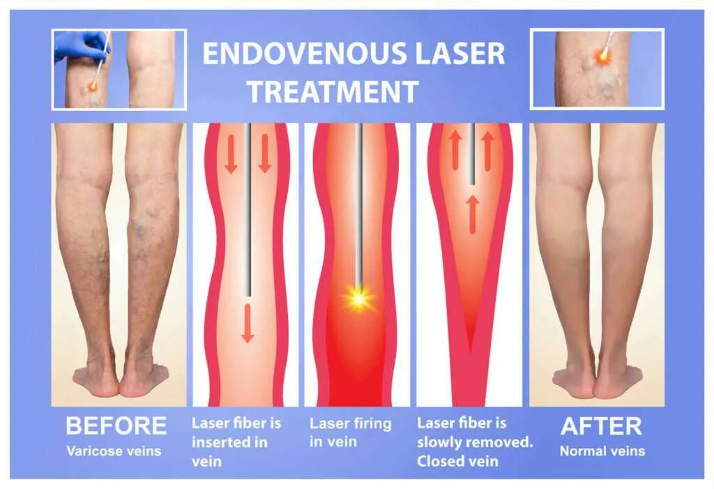 Laser Treatment