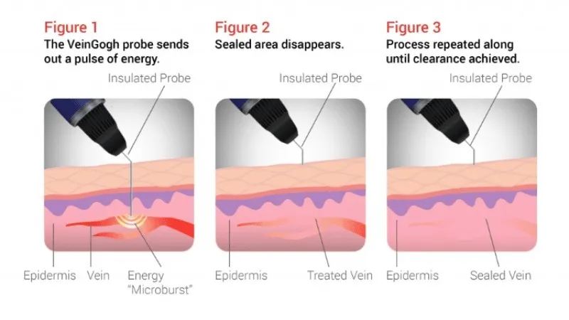 microphlebectomy